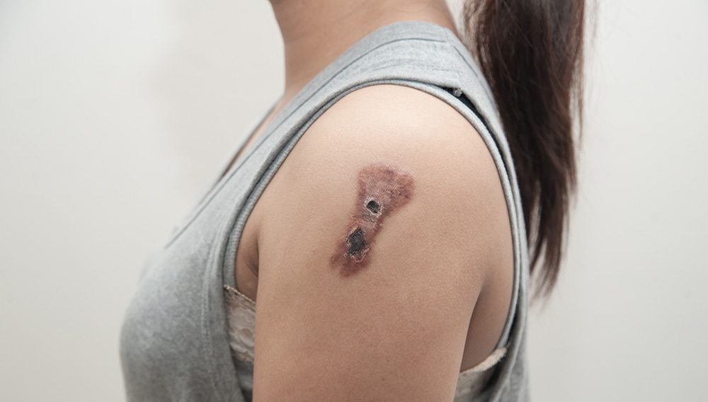 El cáncer de piel es el tipo más común en EEUU. Foto: Shutterstock